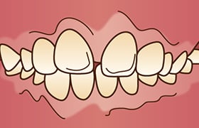 上顎前突［じょうがくぜんとつ］
