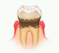 軽度歯周炎